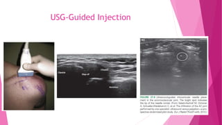 Shoulder Injection Location Chart Shoulder Injection | PPTX
