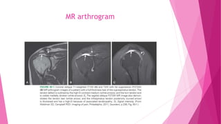 Hip Arthrogram Volume Shoulder Injection | PPTX