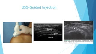 Shoulder Injection Location Chart Shoulder Injection | PPTX