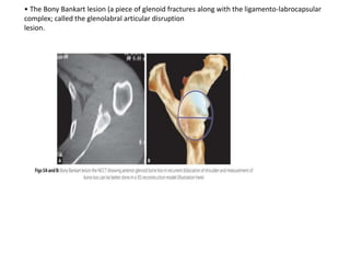 Shoulder instability-1.pptx