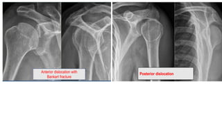 Anterior dislocation with
Bankart fracture
Posterior dislocation
 