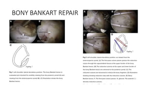 BONY BANKART REPAIR
 