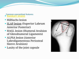 shoulder instability.pptxBBBBBBBBBBBBBBB | PPTX