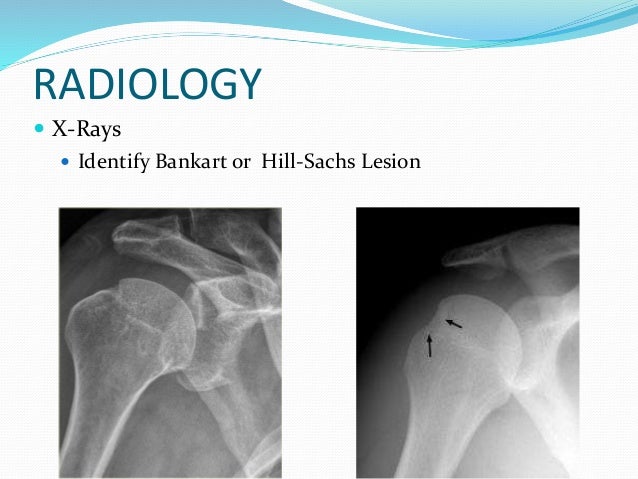 Shoulder instability (anatomy,types, management )