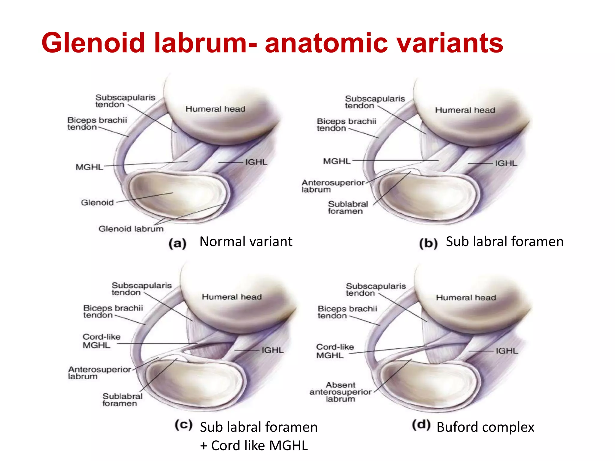 Glenoid labrum- anatomic variants
Normal variant Sub labral foramen
Sub labral foramen
+ Cord like MGHL
Buford complex
 