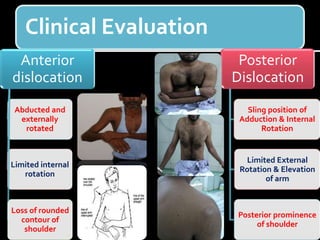 Clinical Evaluation
Anterior
dislocation
Abducted and
externally
rotated
Limited internal
rotation
Loss of rounded
contour of
shoulder
Posterior
Dislocation
Sling position of
Adduction & Internal
Rotation
Limited External
Rotation & Elevation
of arm
Posterior prominence
of shoulder
 