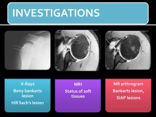 INVESTIGATIONS
X-Rays
Bony bankarts
lesion
Hill Sach’s lesion
MRI
Status of soft
tissues
MR arthrogram
Bankarts lesion,
SlAP lesions
 