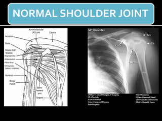 NORMAL SHOULDER JOINT
 