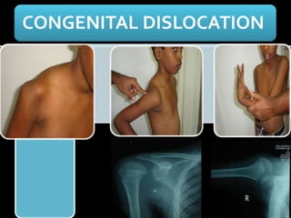 CONGENITAL DISLOCATION
 