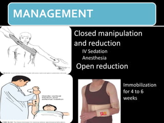 MANAGEMENT
Closed manipulation
and reduction
IV Sedation
Anesthesia
Open reduction
Immobilization
for 4 to 6
weeks
 
