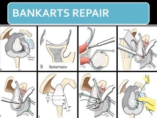 BANKARTS REPAIR
 