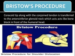 BRISTOW’S PROCEDURE
Coracoid tip along with the conjoined tendon is transferred
to the anteroinferior glenoid neck which acts acts like bone
block in front of the humeral head.
 