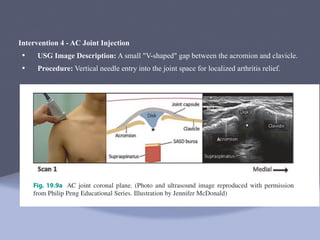 Presentation on precision manangement of shoulder pain: Pathology, USG ...