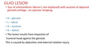 GLAD LESION
• Tear of anteroinferior labrum ( non displaced) with avulsion of adjacent
glenoid cartilage , no capsular stripping.
• G – glenoid
• L – labral
• A – avulsion
• D – defect
• The lesion results from impaction of
humeral head against the glenoid.
This is caused by abduction and external rotation injury.
 