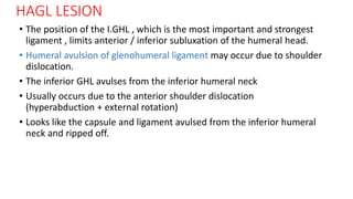 HAGL LESION
• The position of the I.GHL , which is the most important and strongest
ligament , limits anterior / inferior subluxation of the humeral head.
• Humeral avulsion of glenohumeral ligament may occur due to shoulder
dislocation.
• The inferior GHL avulses from the inferior humeral neck
• Usually occurs due to the anterior shoulder dislocation
(hyperabduction + external rotation)
• Looks like the capsule and ligament avulsed from the inferior humeral
neck and ripped off.
 