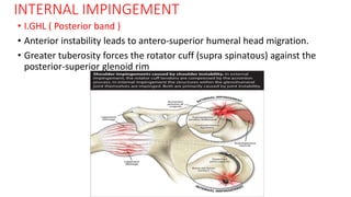 INTERNAL IMPINGEMENT
• I.GHL ( Posterior band )
• Anterior instability leads to antero-superior humeral head migration.
• Greater tuberosity forces the rotator cuff (supra spinatous) against the
posterior-superior glenoid rim
 