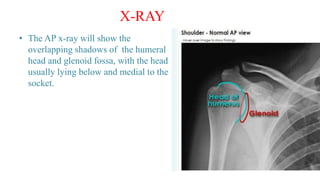 • The AP x-ray will show the
overlapping shadows of the humeral
head and glenoid fossa, with the head
usually lying below and medial to the
socket.
X-RAY
 