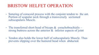 BRISTOW HELFET OPERATION
- Suturing of coracoid process with the conjoint tendon to the ant.
Portion of scapular neck through a transversely sectioned
subscapularis Muscle.
- The transferred short head of biceps & corachobrachialis –
strong buttress across the anterior & inferior aspects of joint
- Tendon also holds the lower half of subscapularis Muscle. Thus
prevents slipping over the humeral head when abducted.
 
