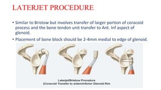 LATERJET PROCEDURE
• Similar to Bristow but involves transfer of larger portion of coracoid
process and the bone tendon unit transfer to Ant. Inf aspect of
glenoid.
• Placement of bone block should be 2-4mm medial to edge of glenoid.
 