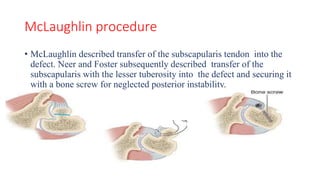 McLaughlin procedure
• McLaughlin described transfer of the subscapularis tendon into the
defect. Neer and Foster subsequently described transfer of the
subscapularis with the lesser tuberosity into the defect and securing it
with a bone screw for neglected posterior instability.
 