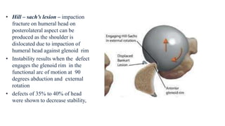 • Hill – sach’s lesion – impaction
fracture on humeral head on
posterolateral aspect can be
produced as the shoulder is
dislocated due to impaction of
humeral head against glenoid rim
• Instability results when the defect
engages the glenoid rim in the
functional arc of motion at 90
degrees abduction and external
rotation
• defects of 35% to 40% of head
were shown to decrease stability,
 