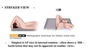 • STRYKER VIEW -
• Simplest is AP view in internal rotation – often shows a Hill –
Sachs lesion that may not be apparent on routine views .
 