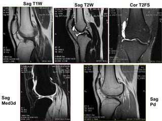 Sag
Med3d
Sag
Pd
Cor T2FSSag T2WSag T1W
 