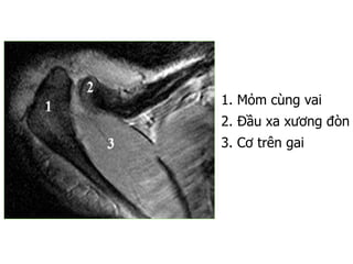 1. Mỏm cùng vai
2. Đầu xa xương đòn
3. Cơ trên gai.
 