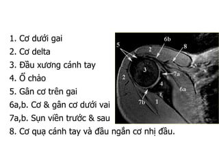 1. Cơ dưới gai
2. Cơ delta
3. Đầu xương cánh tay
4. Ổ chảo
5. Gân cơ trên gai
6a,b. Cơ & gân cơ dưới vai
7a,b. Sụn viền trước & sau
8. Cơ quạ cánh tay và đầu ngắn cơ nhị đầu.
 
