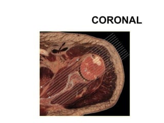 CORONAL
 