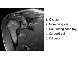 1. Ổ chảo
2. Mỏm cùng vai
3. Đầu xương cánh tay
4. Cơ dướI gai
5. Cơ delta
 