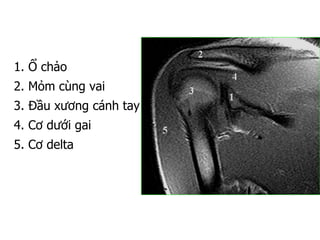 1. Ổ chảo
2. Mỏm cùng vai
3. Đầu xương cánh tay
4. Cơ dưới gai
5. Cơ delta
 
