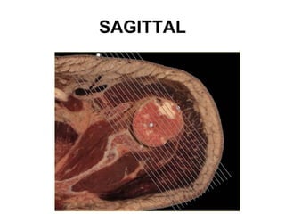 SAGITTAL
 