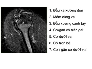 1. Đầu xa xương đòn
2. Mỏm cùng vai
3. Đầu xương cánh tay
4. Cơ/gân cơ trên gai
5. Cơ dướI vai
6. Cơ tròn bé
7. Cơ / gân cơ dướI vai
 