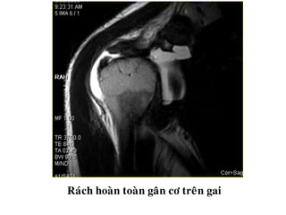 Raùch hoaøn toaøn gaân cô treân gai
 