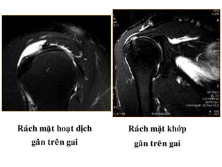 Raùch maët hoaït dòch
gaân treân gai
Raùch mặt khớp
gaân treân gai
 