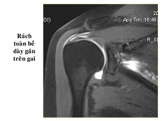 Raùch
toaøn beà
daøy gaân
treân gai
 