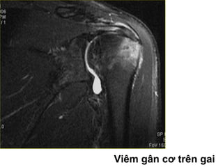Viêm gân cơ trên gai
 