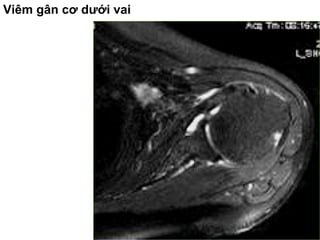 Viêm gân cơ dưới vai
 