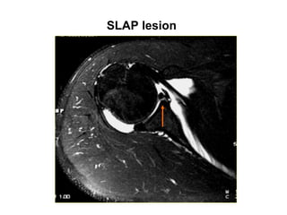 SLAP lesion
 