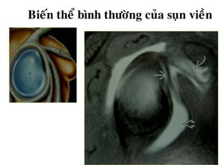 Bieán theå bình thöôøng cuûa suïn vieàn
 