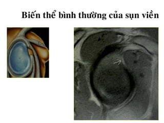 Bieán theå bình thöôøng cuûa suïn vieàn
 