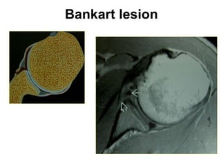 Bankart lesion
 