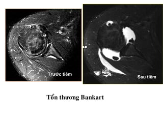 Trước tiêm
Sau tiêm
Toån thương Bankart
 