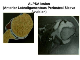 ALPSA lesion
(Anterior Labroligamentous Periosteal Sleeve
Avulsion)
 