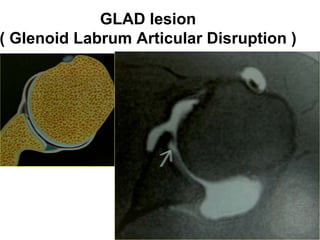 GLAD lesion
( Glenoid Labrum Articular Disruption )
 