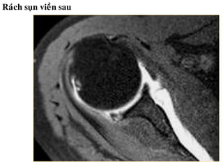 Raùch suïn vieàn sau
 