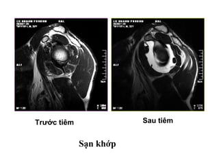 Sau tiêmTrước tiêm
Sạn khớp
 