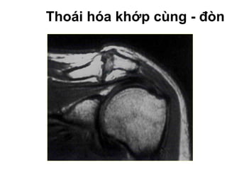 Thoái hóa khớp cùng - đòn
 