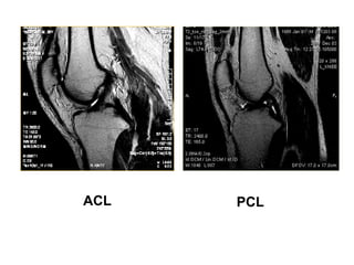 ACL PCL
 